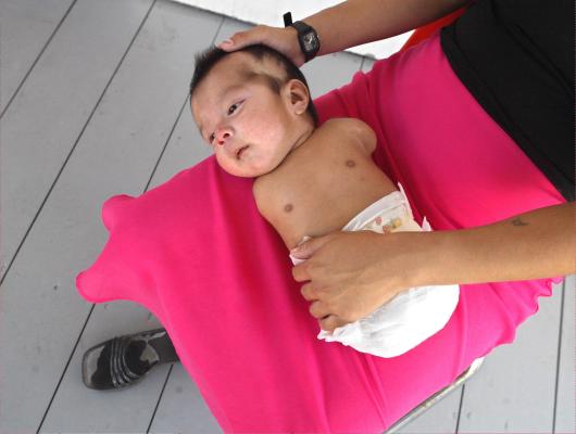 Монсанто - Carlitos - baby with birth defects attributable to pesticides (PBP).jpg